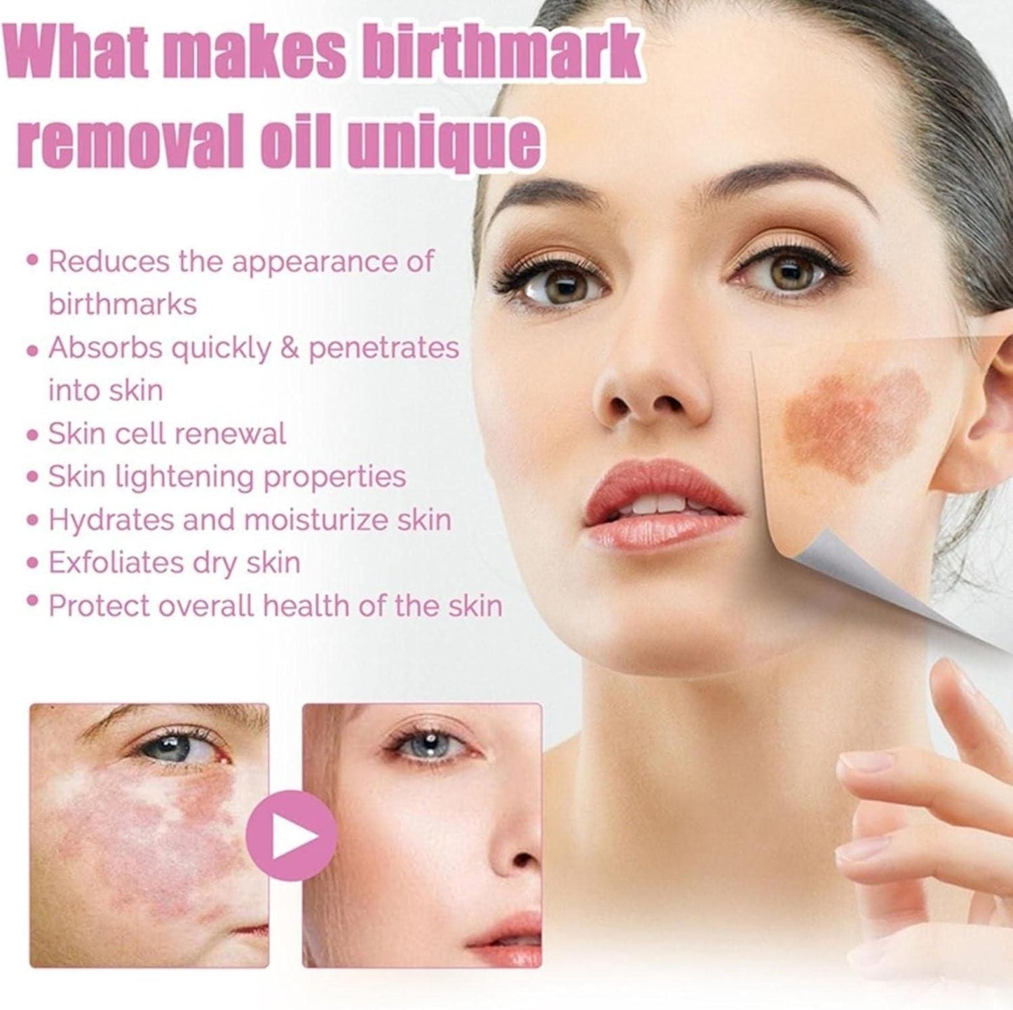 Birthmark Removal Oil 10ML (Buy 1 Get 1 FREE)
