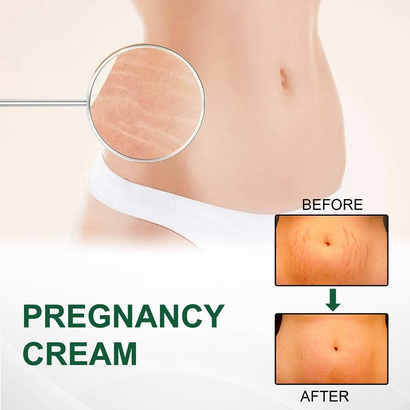 Natural Stretch Marks Removal Cream 50g (Buy 1 Get 1 FREE)