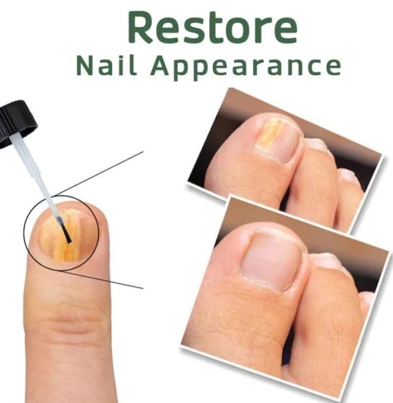 Bee Venom Nail Fungus Solution 10ml Each (BUY 1 GET 1 FREE)
