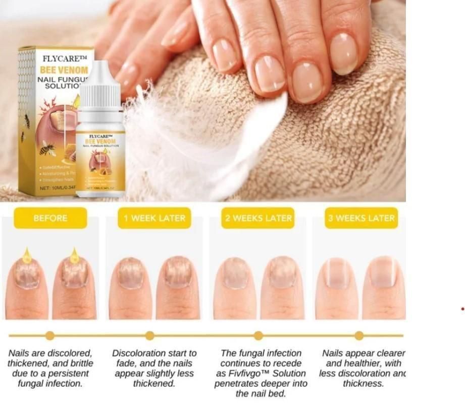 Bee Venom Nail Fungus Solution 10ml Each (BUY 1 GET 1 FREE)