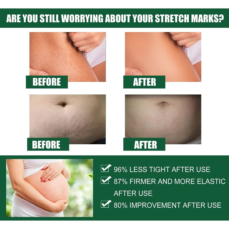 Natural Stretch Marks Removal Cream 50g (Buy 1 Get 1 FREE)