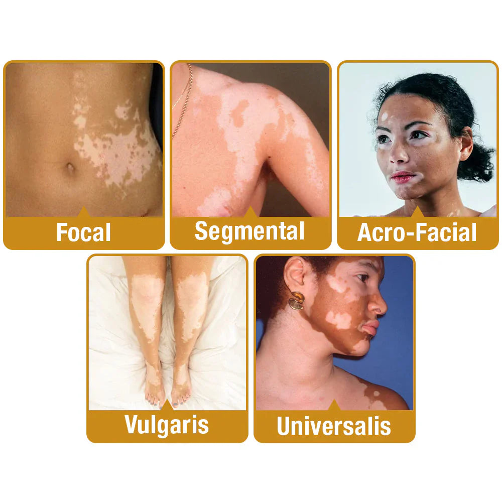 VitiGO Bee Venom Treatment Cream (Buy 1 Get 1 Free)