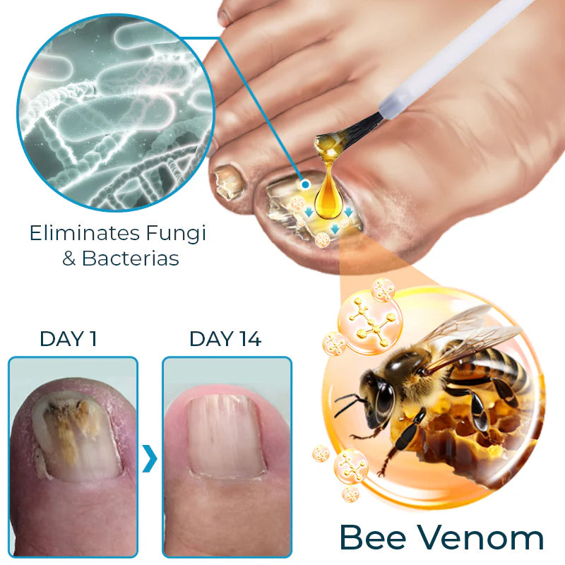 Bee Venom Nail Fungus Solution 10ml Each (BUY 1 GET 1 FREE)