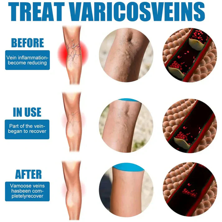 Bee Venom Varicose Veins Spray 🔥 BUY 1 GET 1 FREE 🔥