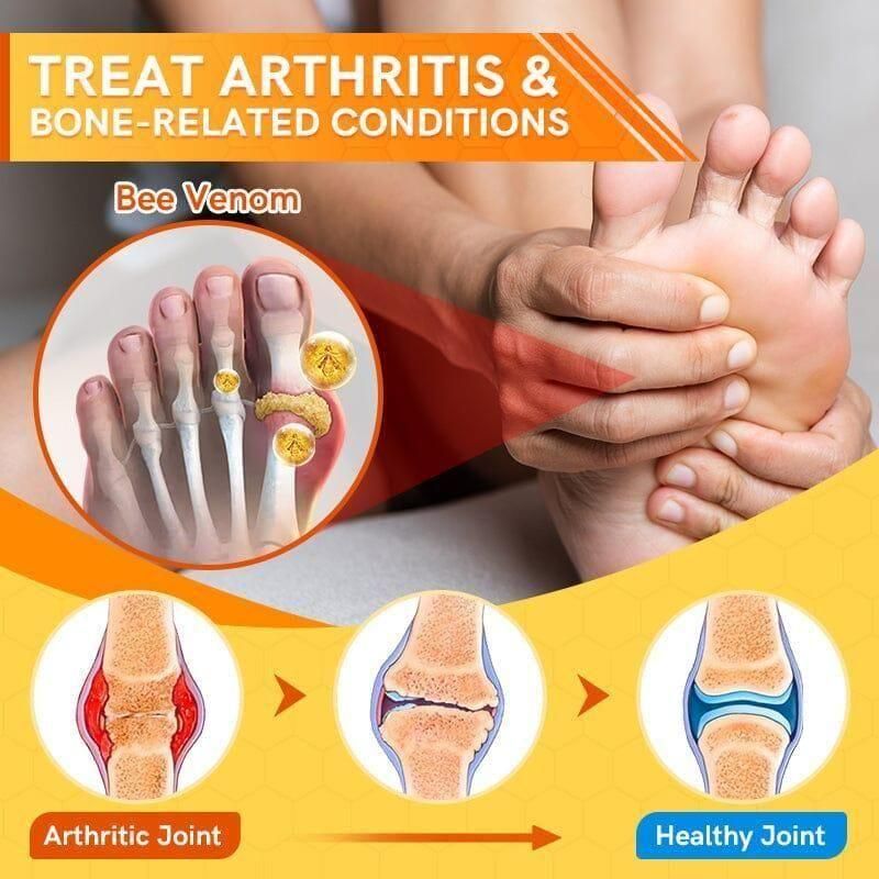 Bee Venom Varicose Veins Spray 🔥 BUY 1 GET 1 FREE 🔥