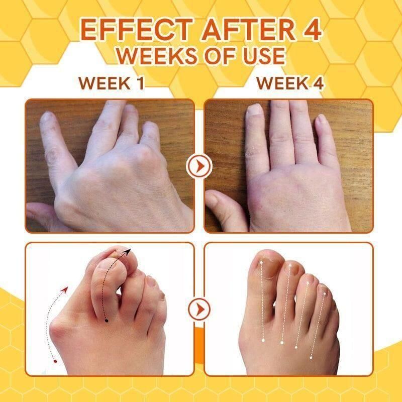 Bee Venom Varicose Veins Spray 🔥 BUY 1 GET 1 FREE 🔥