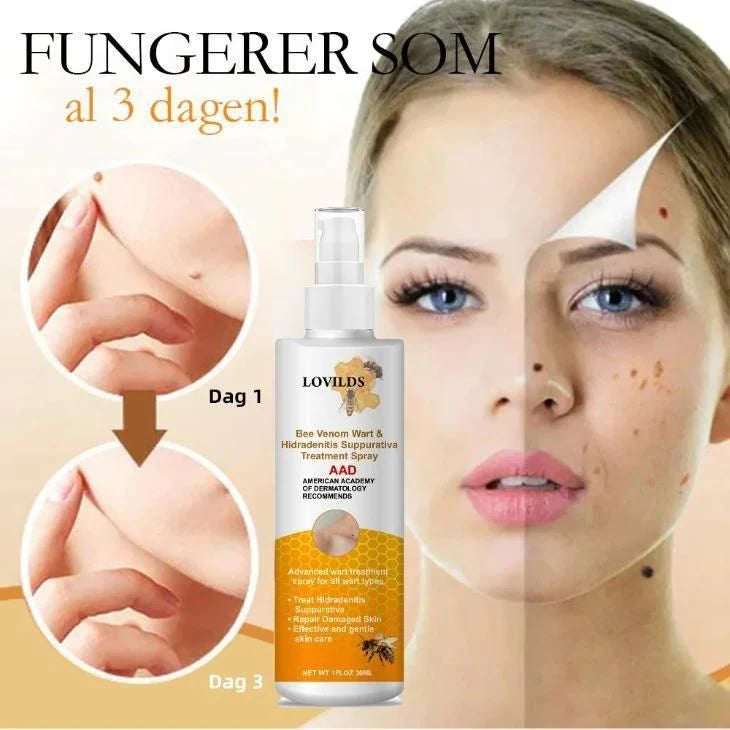 Bee Venom Wart Remover Spray 60ml ( Buy 1 Get 1 Free)