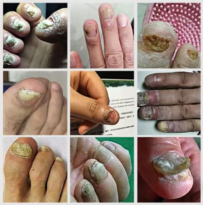 Ingrown Toenail Drops 60 ml Pack of 2