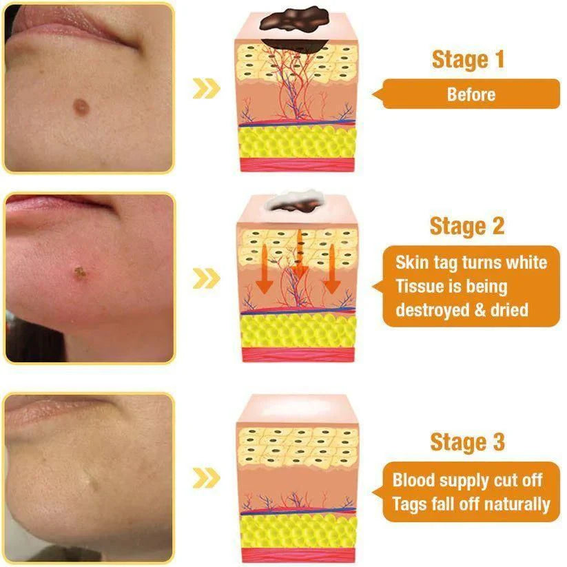 Bee Venom Wart Remover Spray 60ml ( Buy 1 Get 1 Free)