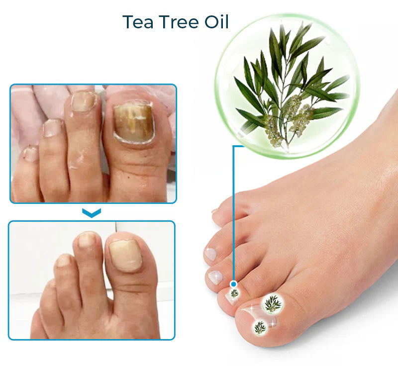 Bee Venom Nail Fungus Solution 10ml Each (BUY 1 GET 1 FREE)